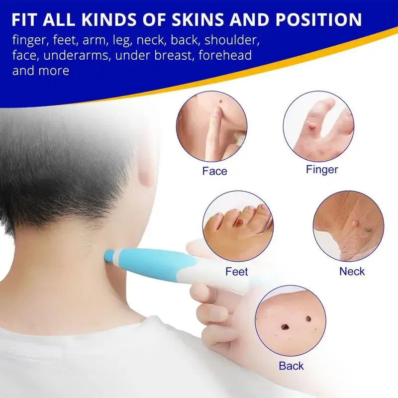 Double Headed Wart Removing Pen Set Auto Skin Tag Remover Painless Mole Wart Remover Skin Tag Removal Kit Skin Care Beauty Tool